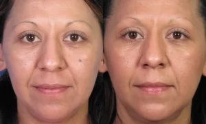 Mole Removal San Diego